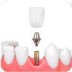 Implante dental