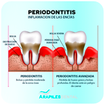 Periodontitis