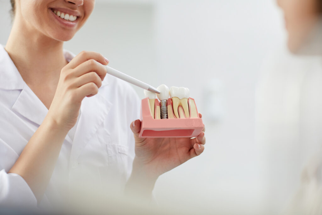 implantes dentales de carga inmediata